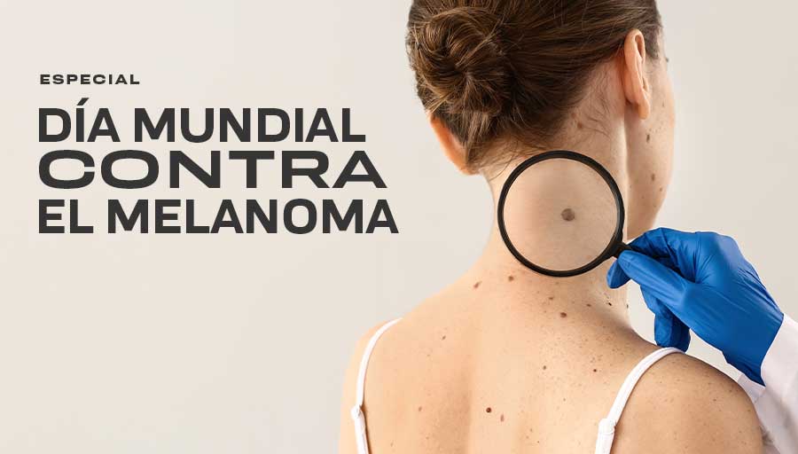 Melanoma: Cómo identificarlo, prevenirlo y actuar a tiempo