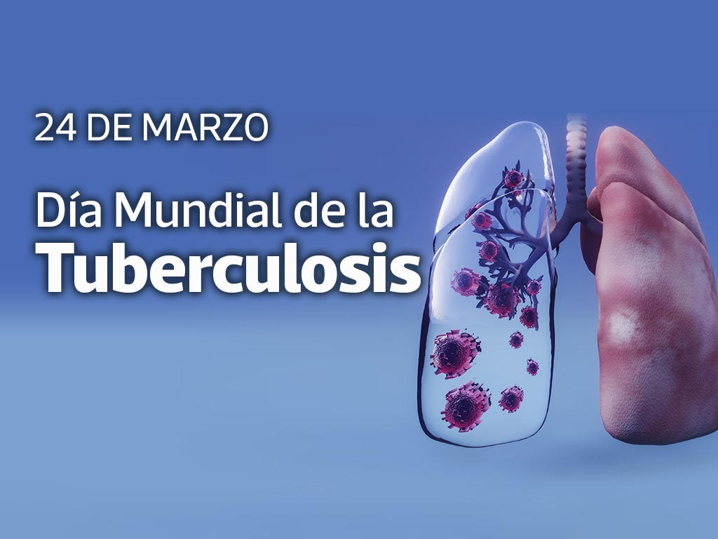 Tuberculosis: una urgencia global que Cuba enfrenta con un modelo de salud equitativo